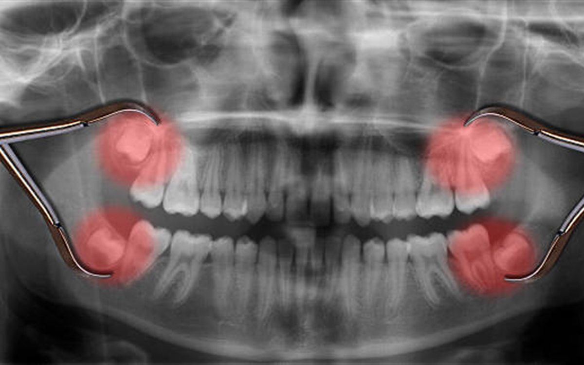 Dental X-ray image showing wisdom teeth assessment