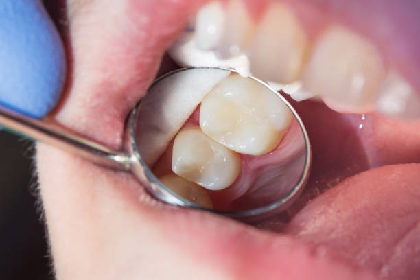 Tooth-colored fillings in Clarenville
