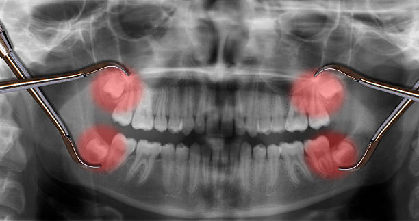 Wisdom teeth removal in Clarenville